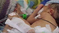 Najmenšie oddelené siamské dvojičky na svete. Mali len osem dní