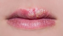 Z lekární i nemocníc sťahujú liek na herpes