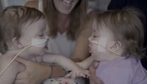 Lekári sa báli, že sa nemusia dožiť operácie. Teraz tieto siamské dvojičky úspešne oddelili