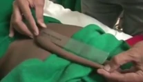 Indický tínedžer žil s 18-centimetrovým chvostom, teraz ho museli odrezať