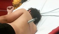 Nebezpečná trampolína: Chlapec pri skákaní skončil s pružinou zabodnutou v tele