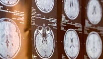Pri mozgovej príhode rozhodujú minúty. Neurochirurg opísal príznaky, ktoré netreba ignorovať