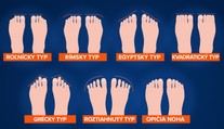 Viete, aký máte typ chodidla? Podľa tvaru zistíte, aké zdravotné problémy vám hrozia