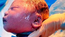 Lekári neverili vlastným očiam. Bábätko malo okolo krku šesťkrát omotanú pupočnú šnúru