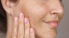 Slnečné lúče, citrusy a figy: Odkiaľ sa berú pigmentové fľaky na pokožke a ako sa ich zbaviť?