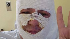 Nešťastný incident slovenského politika. Pri nesprávnej manipulácii s biokrbom utrpel vážne popáleniny tváre