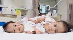 Nima a Dawa boli spojené trupmi, po úspešnej operácii už budú žiť oddelene