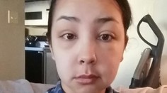 Hrozná alergická reakcia. Žena tak opuchla, až ju nespoznáte