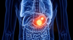 Nenápadná baktéria môže spustiť vážne ochorenie. Odborníci radia, čo robiť, aby ľudia predišli rakovine žalúdka