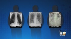 Porovnanie snímok pľúc je šokujúce: Po-covidové sú oveľa horšie ako pľúca tuhých fajčiarov