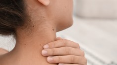 Znamienka, jazvy a pigmentové škvrny v lete. Dermatologička vysvetľuje, ako ich chrániť pred slnečným žiarením