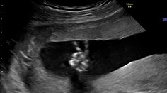 Dvadsaťtýždňové bábo poslalo rodičom z bruška radostný odkaz