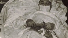 Unikátny zákrok. Lekár si musel slepé črevo operovať sám