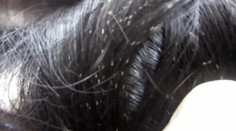 Vši v Hurbanove! Nikto ich však nerieši