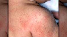 Prvý prípad importovaných osýpok na Slovensku: Študent nebol očkovaný