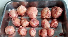 Indka trpela ukrutnými bolesťami pri menštruácii. V tele mala 50 nádorov