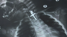 Šokujúca snímka z röntgenu. Dieťaťu sa zasekol v pažeráku krucifix