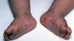 Na Slovensku pribúdajú prípady svrabu, najviac ohrozené sú deti a tínedžeri