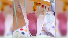 Záhadná zlomenina. Nemocnica tvrdí, že novorodenec si privodil zranenie sám