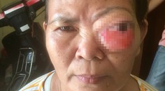 Žena trpí príšernými bolesťami a prichádza o zrak. Nádor jej zdeformoval tvár