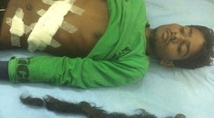 Chlapec chudol a zvracal. Lekári v jeho tele našli parazitické dvojča