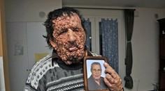 Príbeh Slonieho muža zaujal celý svet