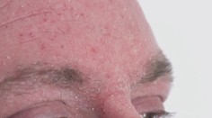 Páli a štípe vás koža? Slováci hlásia veľké problémy. Odborníčky radia, čo robiť