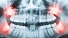 Vedci zistili, prečo nám zuby múdrosti rastú až na prahu dospelosti