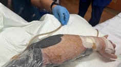 Mäsožravá infekcia mu takmer vzala život. V jednu chvíľu mi bolo vidieť skrz ruku, popísal