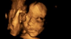 Unikátka operácia. Dieťa vybrali matke z maternice a po operácii vrátili späť