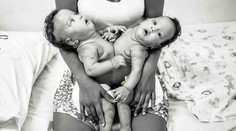 Nádherné snímky. Takto vyzerajú siamské dvojčatá po oddelení