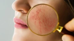 Trápi vás začervenaná tvár či karfiolový nos? Dermatologička radí, ako ich liečiť