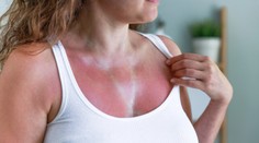 Letné slnko je čoraz silnejšie. Pokožka sa na ňom nemusí iba spáliť, ale môže sa zmeniť aj vaša DNA