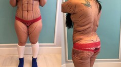 Odsali jej tuk a vpichli ho do zadku. Toto je výsledok