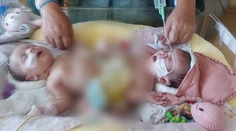 Siamské dvojčatá spod Tatier čaká zlomová operácia. Oddelia ich na prestížnej klinike v Saudskej Arábii