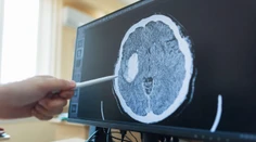 Revolúcia v liečbe rakoviny: Nový test skrátil diagnostiku nádorov mozgu z týždňov na hodiny