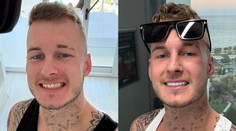 Rovný a biely úsmev. Rozprávali sme sa so Slovákom, ktorý si dal spraviť v Turecku zuby