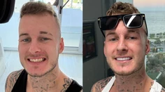 Rovný a biely úsmev. Rozprávali sme sa so Slovákom, ktorý si dal spraviť v Turecku zuby