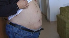 Muž mal 140 kíl. Nechal si odstrániť takmer celý žalúdok