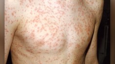 Ďalší prípad podozrenia osýpok v Bratislave: Prípad preverujú hygienici