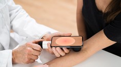 Rýchlejšia diagnostika rakoviny kože vďaka novému objektívu. Pripojiť sa dá na smartphone