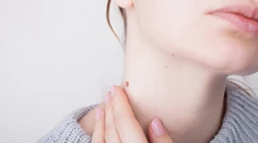 Nesprávna diagnóza ju mohla stáť život: Žena varuje pred nebezpečenstvami rakoviny kože