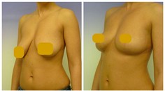 Nepáči sa vám, aké zostali prsia po dojčení? Urobte radikálny krok