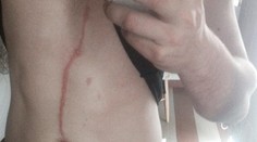 Z dovolenky na Bali si priniesol nechutný suvenír. Usadil sa mu rovno pod kožou