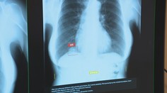 Umelá inteligencia v nemocniciach: Pozrite sa, ako pomáha na rádiológii