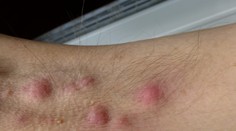 Neliečiteľné ochorenie kože trápi každého stého človeka. Vedci prišli na zaujímavú súvislosť