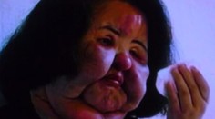 Túžila po plastike a zmenila sa na netvora!