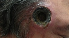 Muž používal výrobok alternatívnej medicíny. Teraz má dieru v hlave