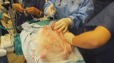 Unikátna záchrana novorodenca. Lekári operovali dieťatko priamo počas pôrodu