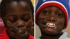 Šimpanzy mu znetvorili tvár. Dnes má za sebou prvú operáciu